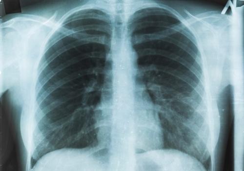 X-ray image of healthy chest showing bones and lungs